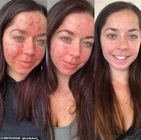 Personal trainer who had the 'worst acne ever seen' shares her striking ...