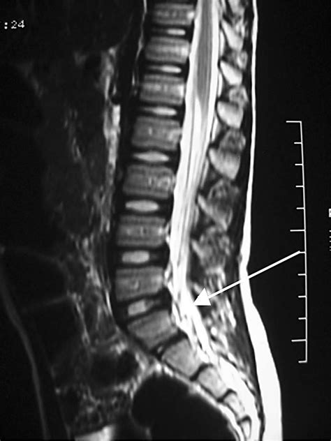 Mri Lumbar Spine Nerve Roots