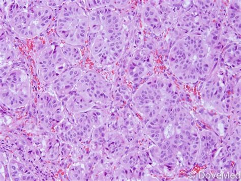 Lung Adenocarcinoma Histology