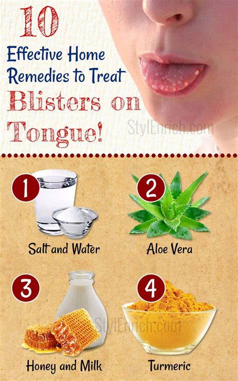 Home Remedies For Blisters on Tongue : How To Treat Tongue Blisters