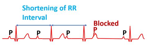 Features of Wenckebach Phenomenon – All About Cardiovascular System and ...