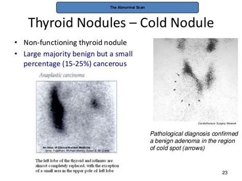 Thyroid pathophysiology scintigraphy[1]