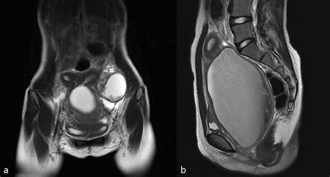 (a) T2 coronal view, (b) T2 sagittal view of pelvic cavity MRI of Case ...