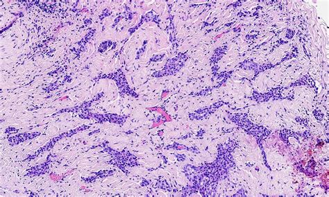 Epithelioid Mesothelioma Pathology Outlines - Goimages 411