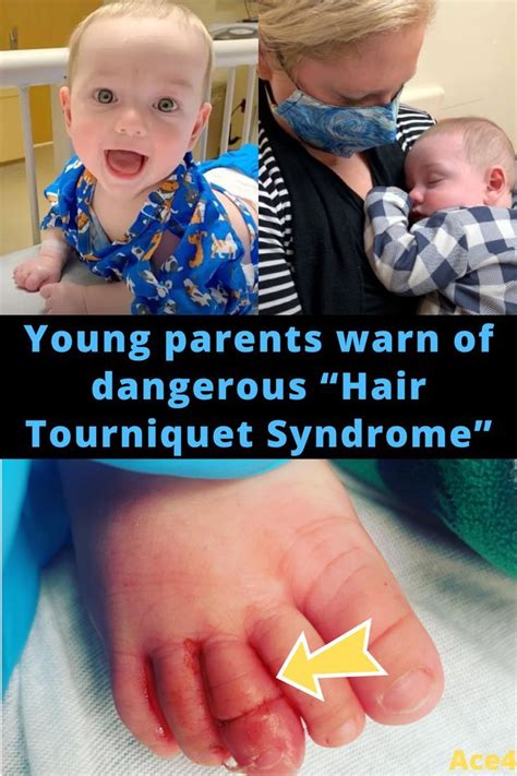 Young parents warn of dangerous "Hair Tourniquet Syndrome" in 2022 ...