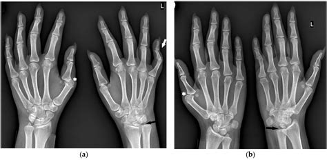 JCM | Free Full-Text | Hand and Wrist Involvement in Seropositive ...