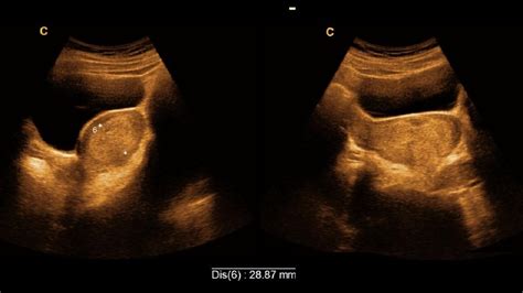 Arcuate uterus | Thickened endometrium | Ultrasonography report | Amader hospital | আমাদের ...