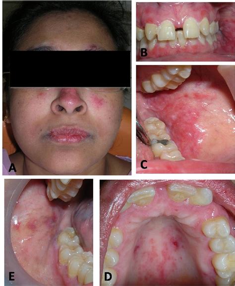 Figure 1 from Oral Manifestations of Systemic Lupus Erythematosus: A Case Report | Semantic Scholar