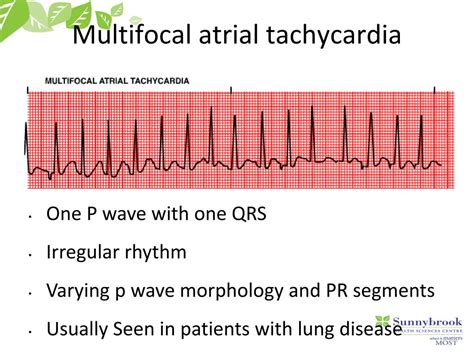 PPT - APPROACH TO TACHYCARDIA PowerPoint Presentation, free download ...