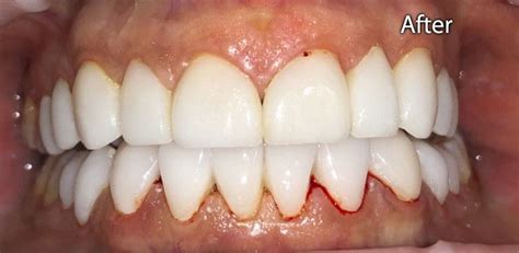 Smile Gallery – All Dental & Braces