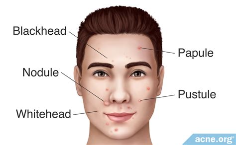 What Is an Acne Pustule?