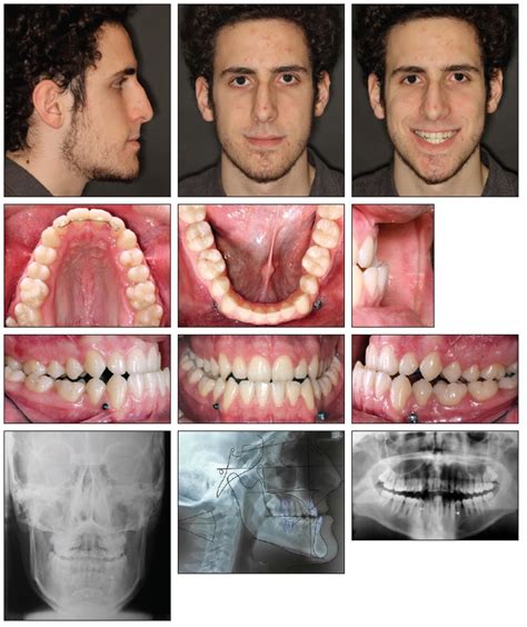 Palate Expander Before And After