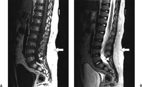 Imaging of Tethered Spinal Cord | Neupsy Key