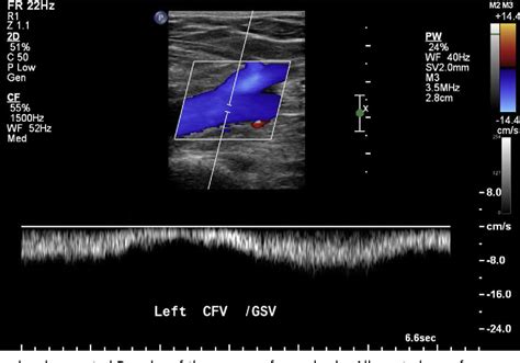 Lower Extremity Venous Ultrasound