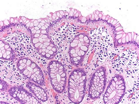 Hyperplastic polyp (goblet cell subtype) | Hyperplastic poly… | Flickr