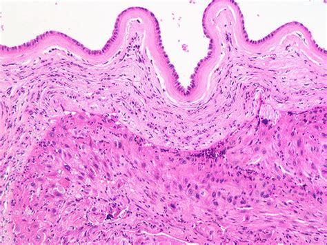 Pathology Outlines - Chorioamnionitis