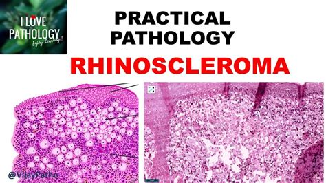 Practical Pathology: RHINOSCLEROMA - YouTube