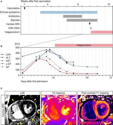 Frontiers | Case Report: Cytomegalovirus Reactivation and Pericarditis Following ChAdOx1 nCoV-19 ...