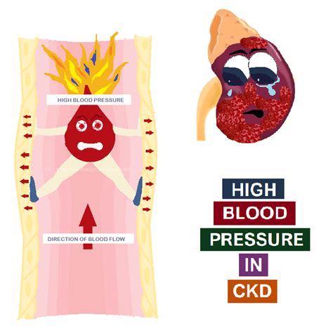 High Blood Pressure in CKD - All Things Kidney ~ Official