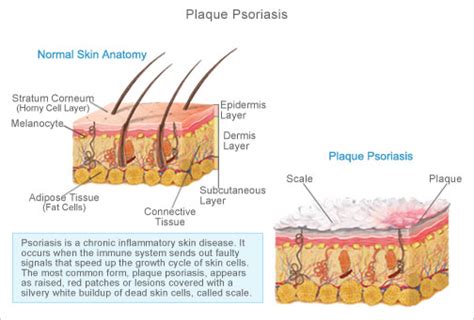 Psoriasis Natural Treatment BLOG: Five Main Types of Psoriasis