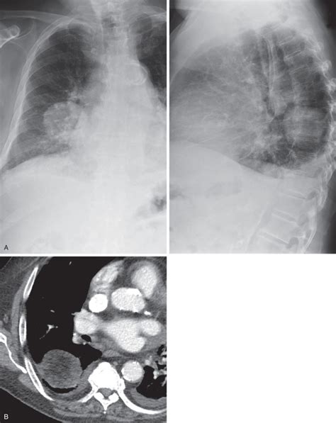 Pulmonary Hamartoma | Radiology Key