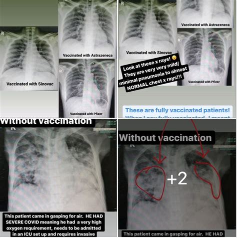 Heboh Rontgen Paru-paru Pasien Covid yang Vaksin & Tidak