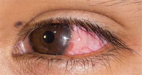 Corneal Infection and Other Causes of Red Eye | Rila Institute of Health Sciences