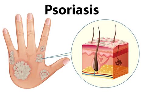 Koebner Phenomenon: Injuries That Trigger Psoriasis Flare-Ups - MYPsoriasis