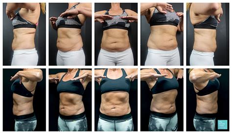 CoolSculpting Stomach / Abdomen, Flanks – Before and After Photos, Reviews