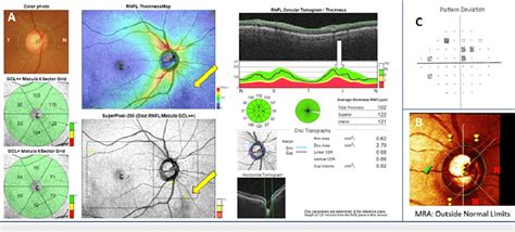 A 65-year-old female with primary open-angle glaucoma in the right eye.... | Download Scientific ...