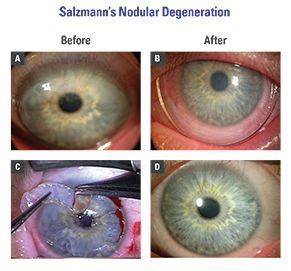 Salzmann’s Nodular Degeneration | Diseases of the eye, Eye health, Ocular