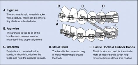 How Do Braces Move Teeth? | Zaki Orthodontics | VA Beach