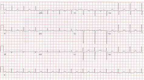 EKG Examples | Torrey EKG