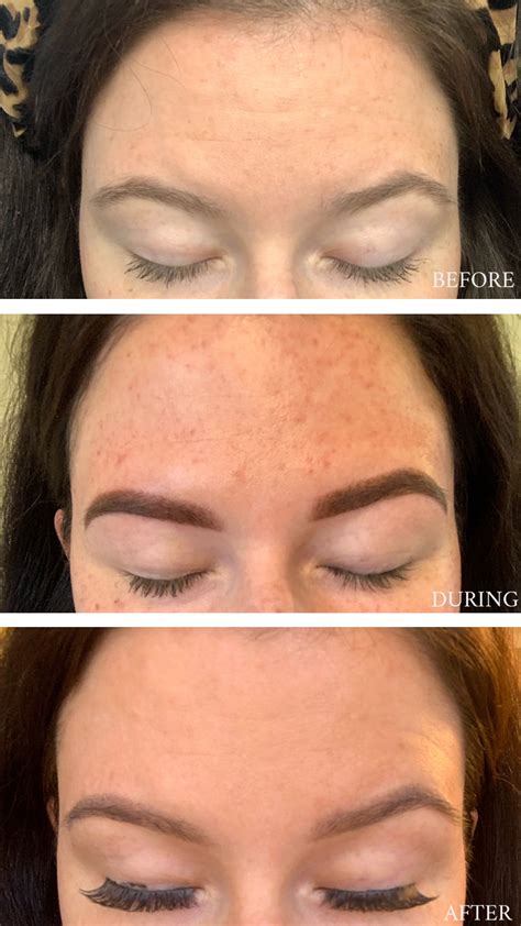 IPL Photofacial - The Polished Approach