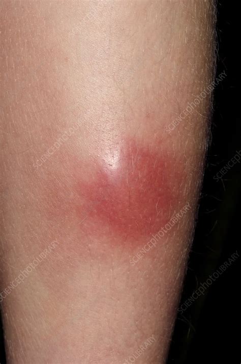 Abscess on leg following insect bite - Stock Image - C013/5803 ...