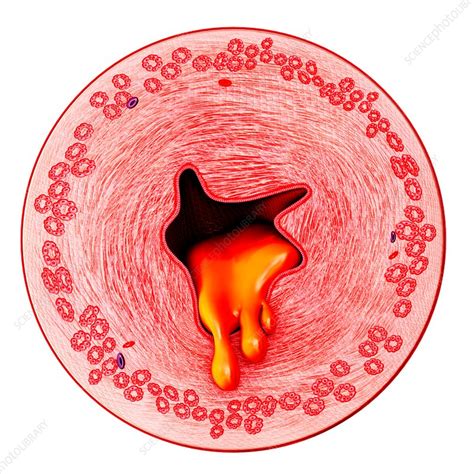 Bronchus with excess mucus, illustration - Stock Image - F020/1000 ...