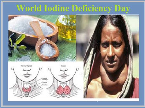 Iodine Deficiency Causes