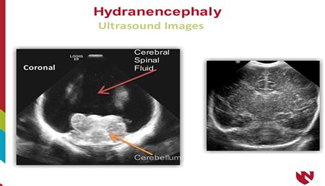 Hydranencephaly Ultrasound