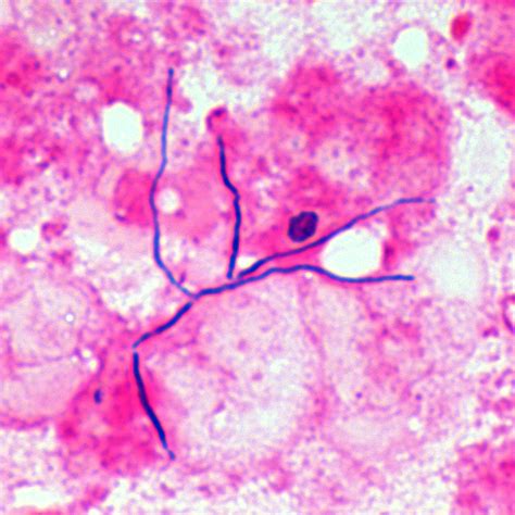 Actinomycosis