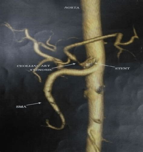 Stent placement for celiac artery stenosis | Download Scientific Diagram