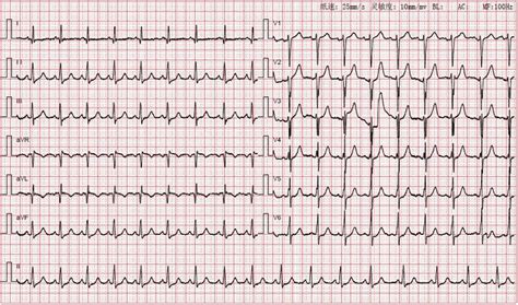 Electrocardiogram (ECG) showing sinus tachycardia with abnormal Q waves | Download Scientific ...