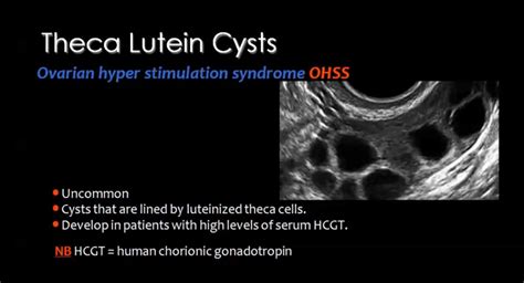 Theca Luteum Cyst