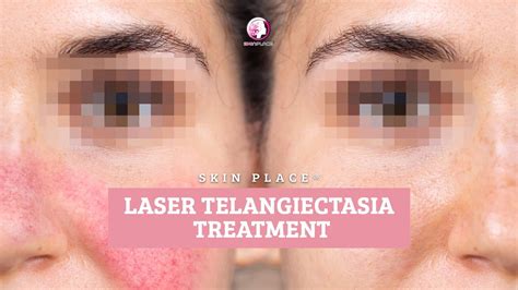 Skin Place Laser Telangiectasia Treatment - YouTube