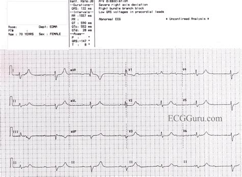 Third-degree AV Block and Junctional Escape Rhythm With Right Bundle Branch Block and Prolonged ...