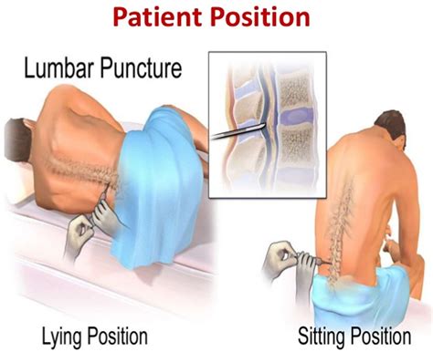 Lumbar Puncture Procedure - Position & Lumbar Puncture Side Effects