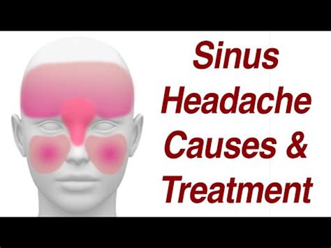 Sinus Headaches: Causes & Treatment - YouTube