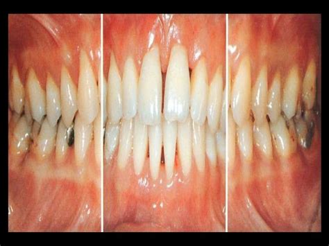 Aggressive periodontitis