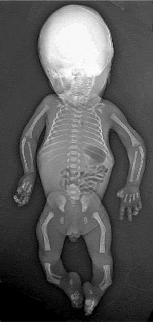 Figure 3. [Classic radiographic features of campomelic ...