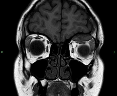 Subperiosteal Orbital Hematoma- Clinical Advisor