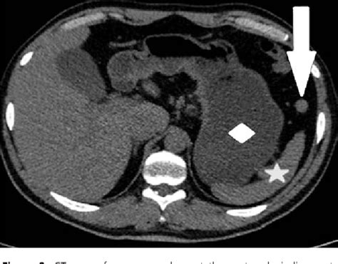 Structure of phrenicosplenic ligament | Semantic Scholar